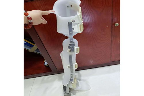 假肢與矯形器的使用周期與更換指南 科學維護，保障生活品質